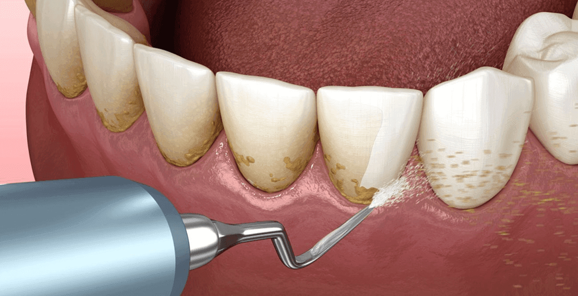 Detartrajul profesional – Esențial pentru o igienă completă, disponibil la Dr. Bălan în Oradea